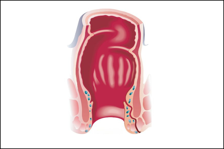 fistula